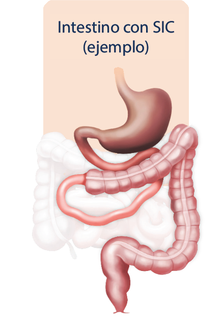 intestino con SIC